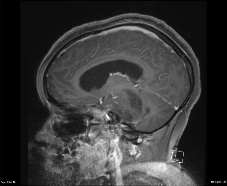 File:Brainstem glioma (Radiopaedia 21819-21775 D 25).jpg