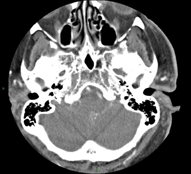 File:Brainstem hemorrhage (Radiopaedia 58794-66028 D 38).jpg