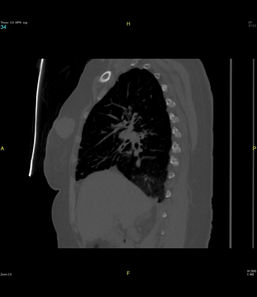Breast primary with lung and bone metastases (Radiopaedia 40620-43228 Sagittal bone window 34).jpg