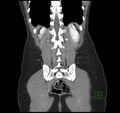 Broad ligament hernia (Radiopaedia 63260-71832 B 31).jpg
