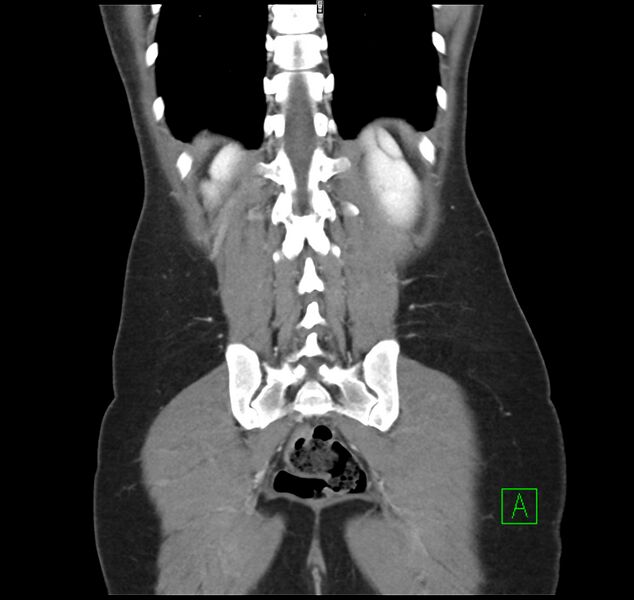 File:Broad ligament hernia (Radiopaedia 63260-71832 B 31).jpg