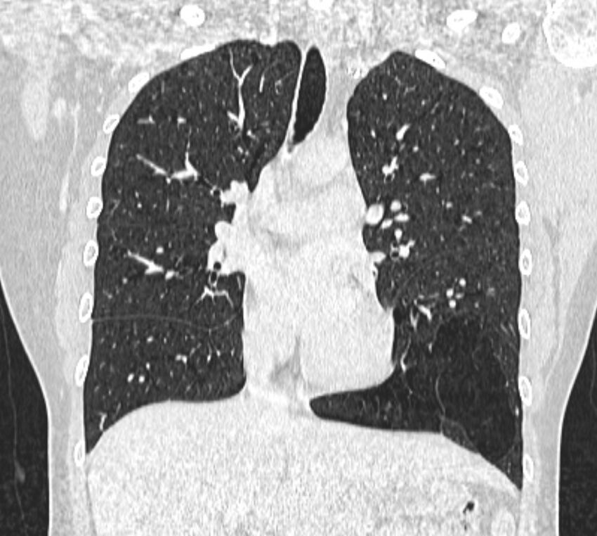 Bronchial atresia (Radiopaedia 50007-55297 Coronal lung window 47).jpg