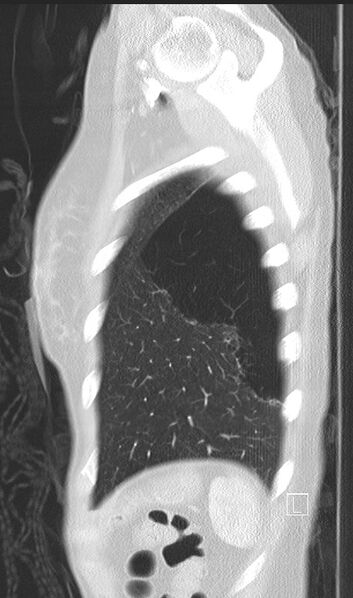 File:Bronchial atresia (Radiopaedia 73677-84470 Sagittal lung window 49).jpg