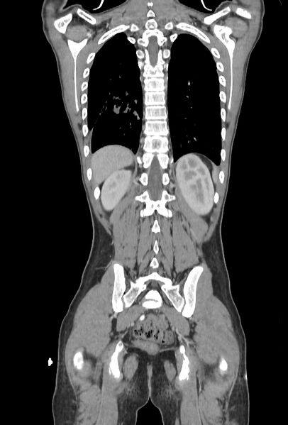 File:Bronchial carcinoid tumor (Radiopaedia 57187-64090 B 95).jpg