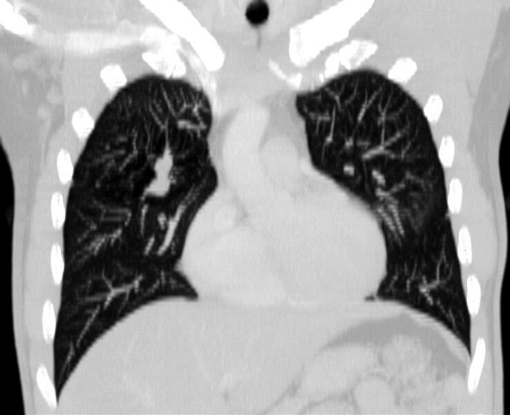 File:Bronchocele (Radiopaedia 12104-12460 Coronal lung window 6).jpg