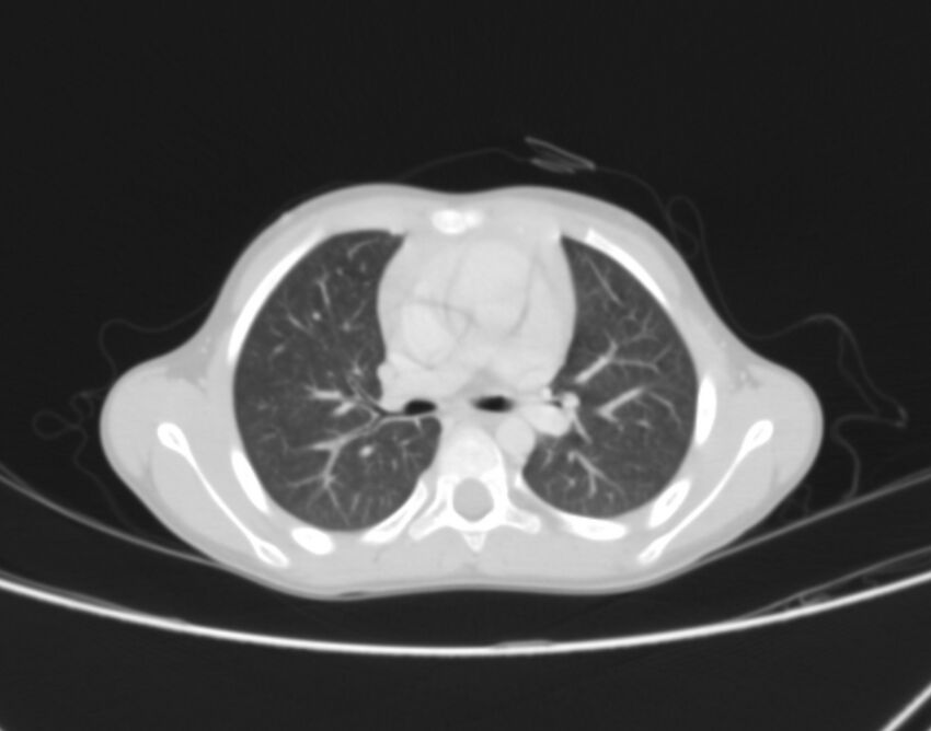 Bronchus suis (Radiopaedia 68131-77620 Axial lung window 33).jpg