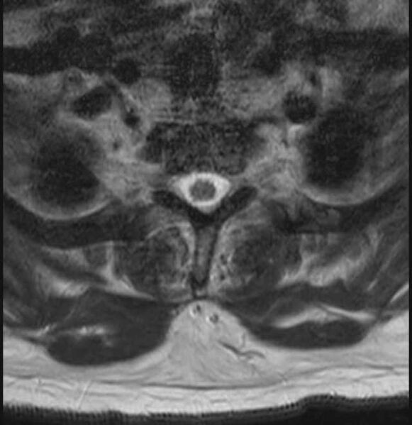 File:Brown tumors compressing the spinal cord (Radiopaedia 68442-78030 A 51).jpg