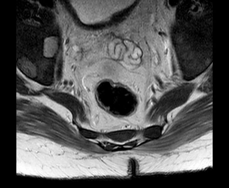 File:Brown tumors compressing the spinal cord (Radiopaedia 68442-78030 Axial T2 - lumbar 1).jpg