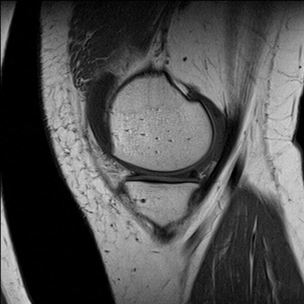 File:Bucket handle tear - medial meniscus (Radiopaedia 79028-91942 Sagittal T1 20).jpg