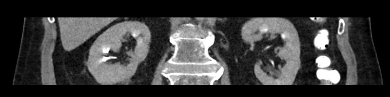 File:Buried bumper syndrome - gastrostomy tube (Radiopaedia 63843-72575 Coronal 32).jpg