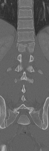 File:Burst fracture - T12 with conus compression (Radiopaedia 56825-63647 Coronal bone window 25).png