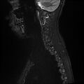 Butterfly vertebra (Radiopaedia 77903-90208 Sagittal STIR 12).jpg