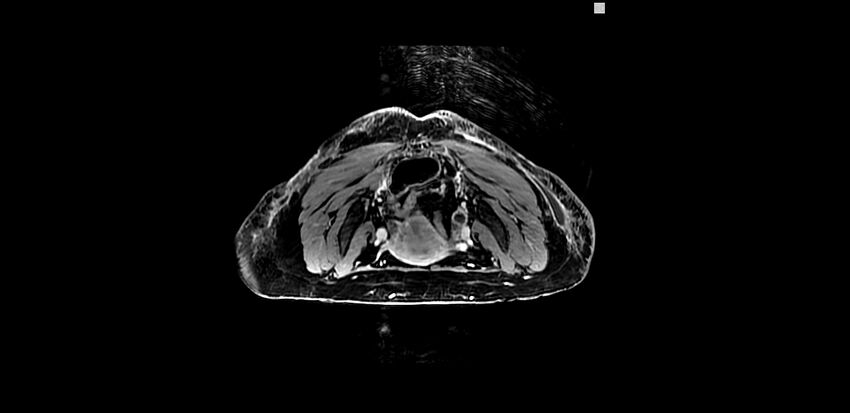 Buttock filler complications (Radiopaedia 63497-72115 Axial T1 C+ 8).jpg