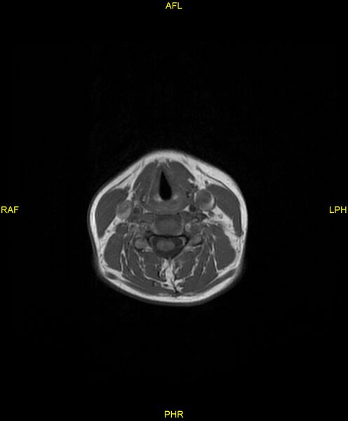 File:C5 nerve sheath tumor (Radiopaedia 85777-101596 Axial T1 14).jpg