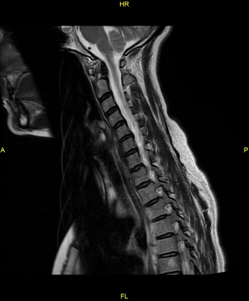 File:C5 nerve sheath tumor (Radiopaedia 85777-101596 Sagittal T2 12).jpg