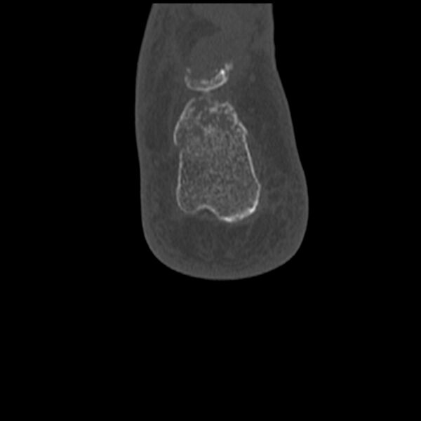 File:Calcaneal tuberosity avulsion fracture (Radiopaedia 22649-22668 Coronal bone window 64).jpg