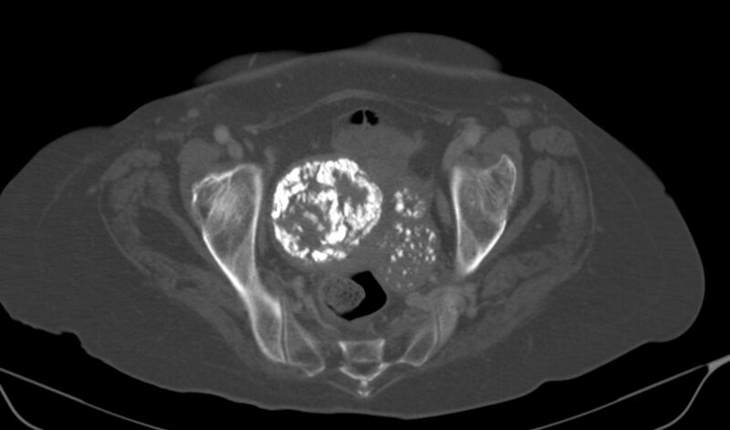 File:Calcified fibroids (Radiopaedia 20306-20228 Axial bone window 18).jpg
