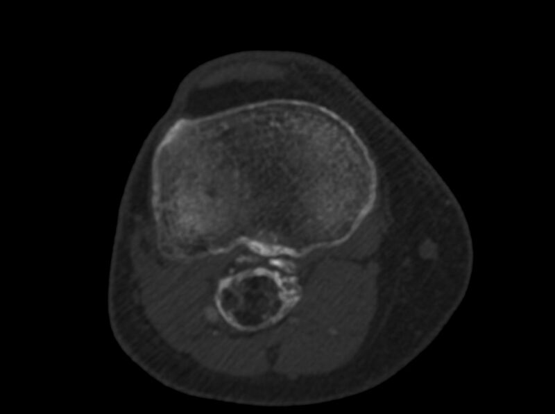 File:Calcified hematoma - popliteal fossa (Radiopaedia 63938-72763 C 47).jpg