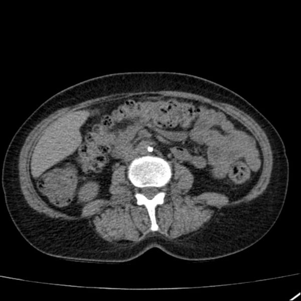 File:Calcified hepatic hydatid cyst (Radiopaedia 26872-27046 Axial non-contrast 46).jpg