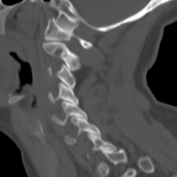 File:Calcified meningioma - cervical canal (Radiopaedia 70136-80171 Sagittal bone window 29).jpg
