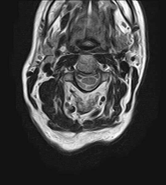 File:Calcified meningioma - cervical canal (Radiopaedia 70136-82468 Axial T2 13).jpg