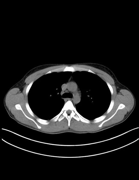 File:Calcifying pulmonary metastases (Radiopaedia 33359-34396 Axial non-contrast 11).jpg