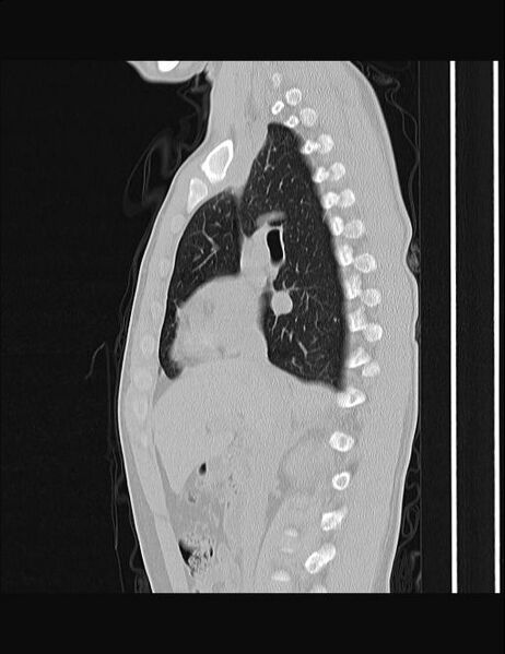 File:Calcifying pulmonary metastases (Radiopaedia 33359-34396 Sagittal lung window 42).jpg
