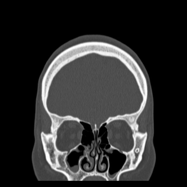 File:Calvarial osteoma (Radiopaedia 36520-38079 C 22).jpg