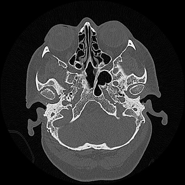 File:Canal up mastoidectomy (Radiopaedia 78108-90638 Axial bone window 39).jpg