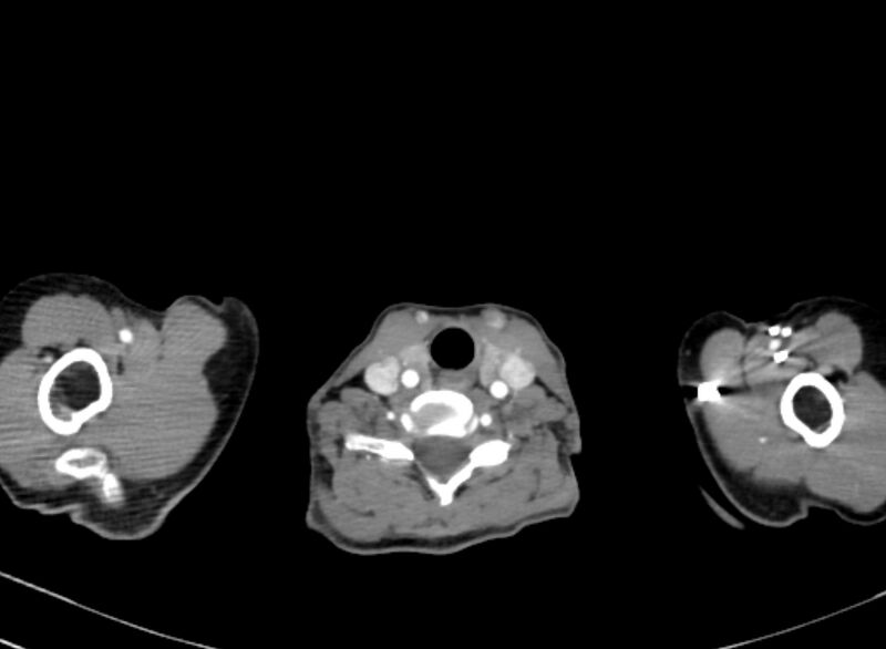 File:Cannonball metastases from breast cancer (Radiopaedia 91024-108569 A 2).jpg