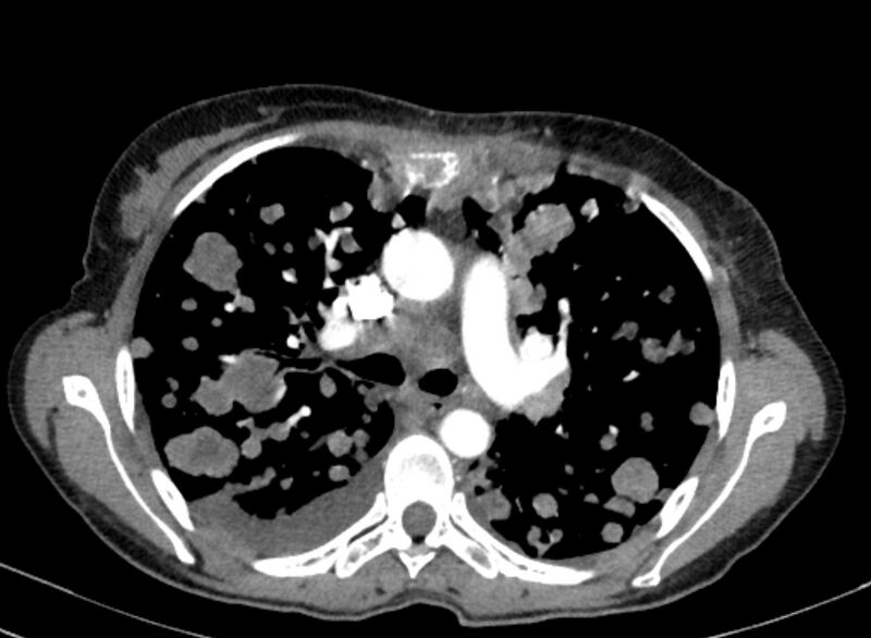 File:Cannonball metastases from breast cancer (Radiopaedia 91024-108569 A 49).jpg