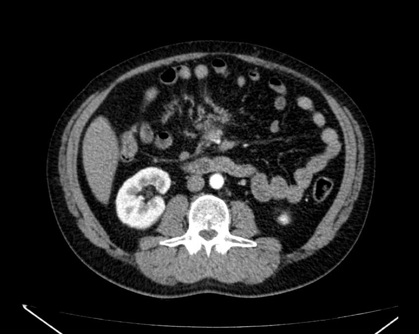 Carcinoid tumor with hepatic metastases (Radiopaedia 22651-22670 B 44).jpg