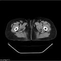 Carcinoma cervix- recurrence (Radiopaedia 34702-36137 B 59).jpg