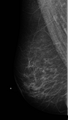 Carcinoma left breast (Radiopaedia 24885-25141 MLO 1).png
