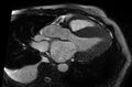 Cardiac amyloidosis (Radiopaedia 61600-69579 B 13).jpg