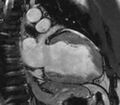 Cardiac sarcoidosis (Radiopaedia 39811-42243 B 11).jpg