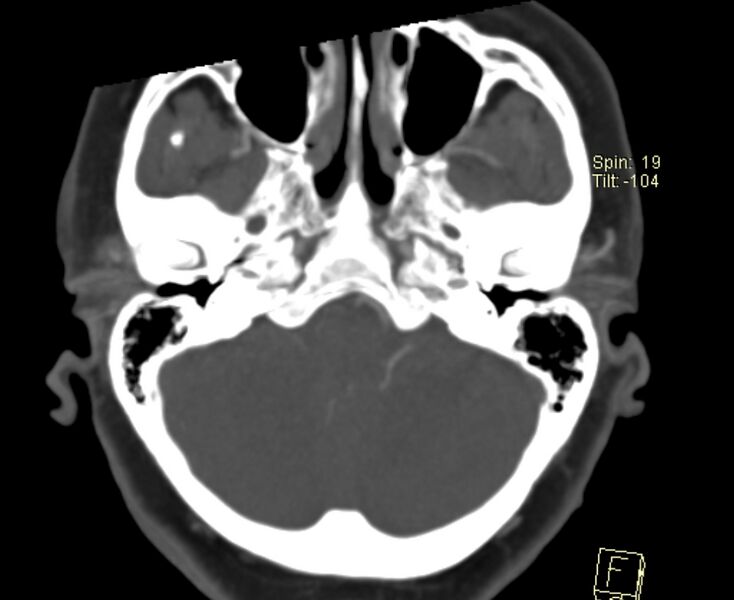 File:Caroticocavernous fistula (Radiopaedia 29565-30069 Axial MIP 3).jpg
