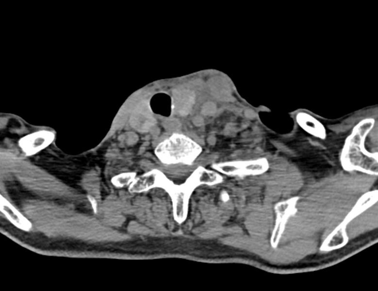 File:Carotid artery pseudoaneurysm (Radiopaedia 84030-99259 Axial non-contrast 46).jpg