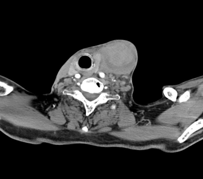 File:Carotid artery pseudoaneurysm (Radiopaedia 84030-99259 C 60).jpg