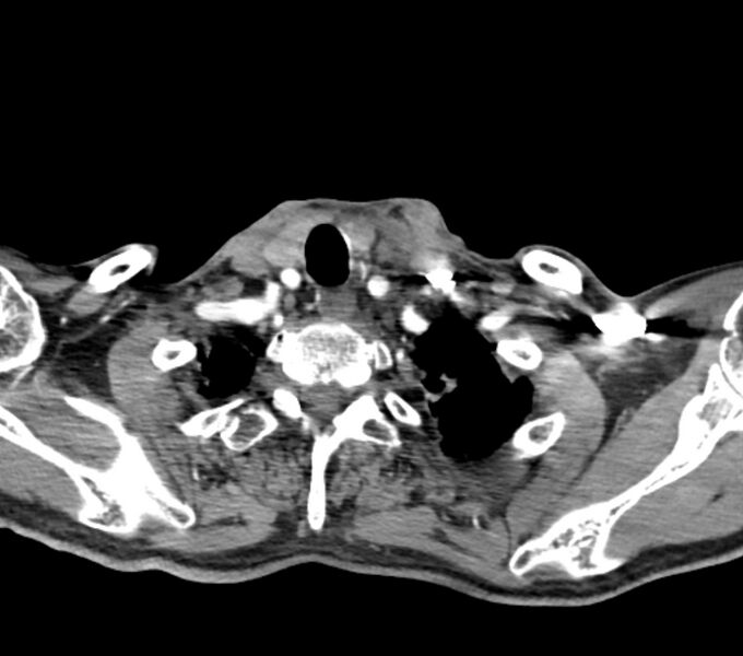 File:Carotid artery pseudoaneurysm (Radiopaedia 84030-99259 C 71).jpg
