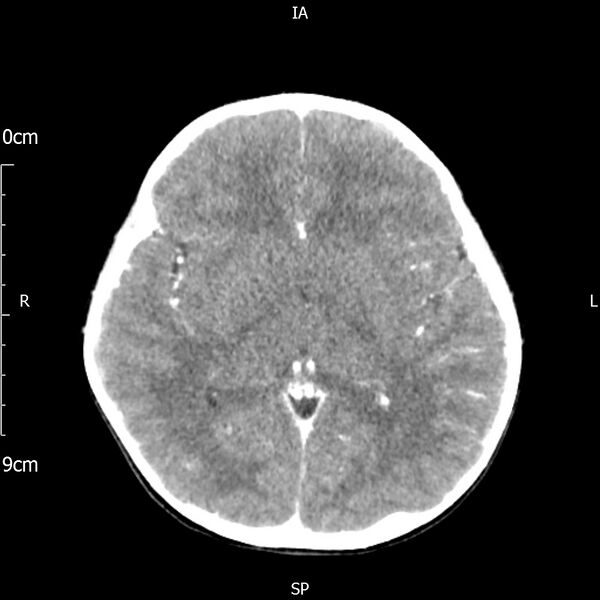 File:Cavernous sinus thrombosis (Radiopaedia 79414-92510 Axial Brain 105).jpg