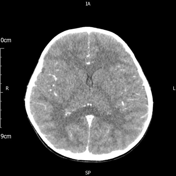 File:Cavernous sinus thrombosis (Radiopaedia 79414-92510 Axial Brain 111).jpg
