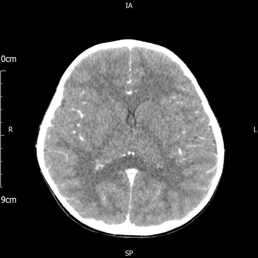 Cavernous sinus thrombosis (Radiopaedia 79414-92510 Axial Brain 111).jpg