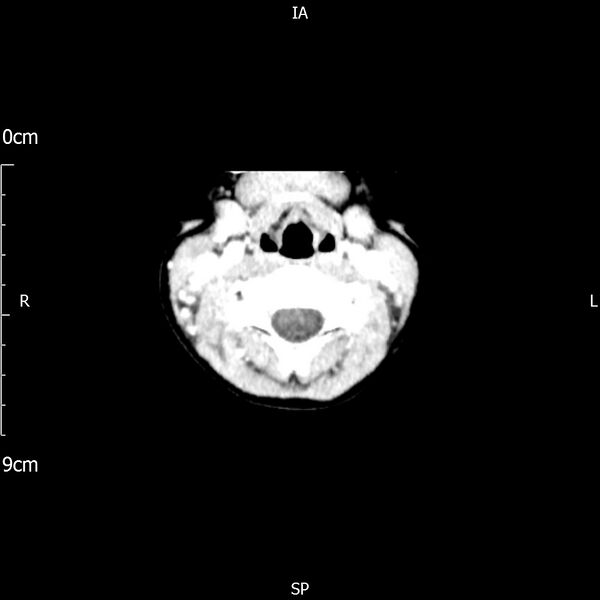 File:Cavernous sinus thrombosis (Radiopaedia 79414-92510 Axial Brain 6).jpg