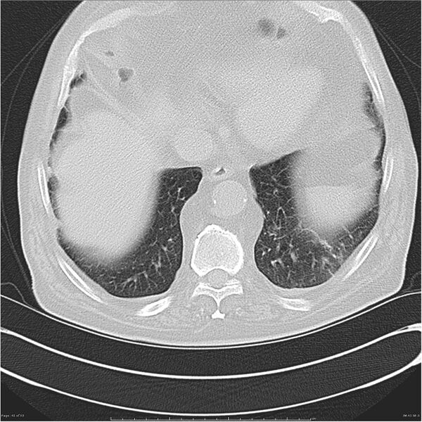 File:Cavitating left lower lobe lesion - squamous cell lung cancer (Radiopaedia 27749-28176 Axial lung window 41).jpg