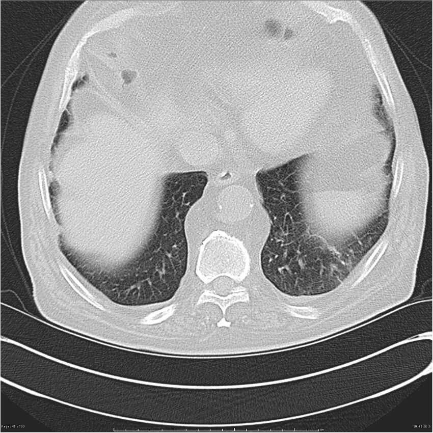 Cavitating left lower lobe lesion - squamous cell lung cancer (Radiopaedia 27749-28176 Axial lung window 41).jpg