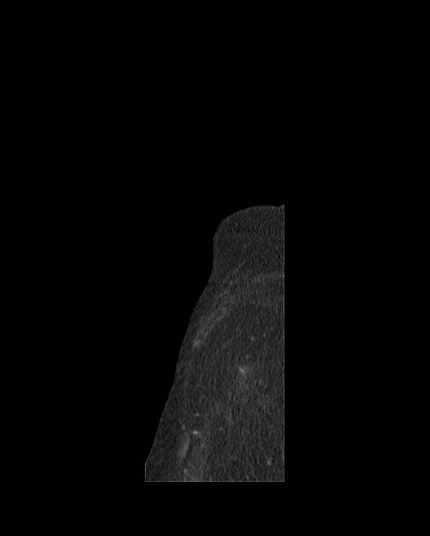 Cecal volvulus (Radiopaedia 54998-61310 C 4).jpg