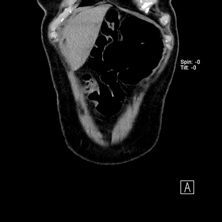 Cecal volvulus (Radiopaedia 90897-108397 Coronal non-contrast 53).jpg