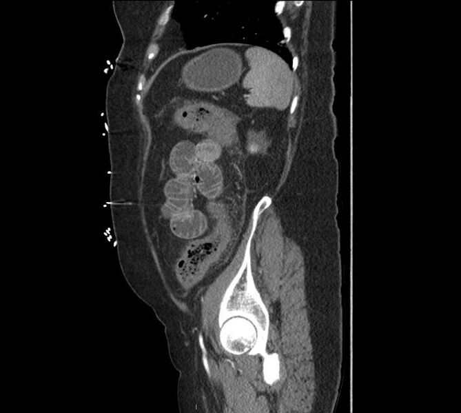 File:Celiac artery severe stenosis and dissection (Radiopaedia 44128-47842 A 8).jpg