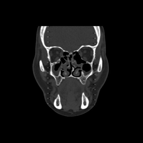 File:Cemento-ossifying fibroma (Radiopaedia 21243-21149 Coronal bone window 9).jpg